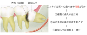 親知らずはなぜ痛くなるのか？