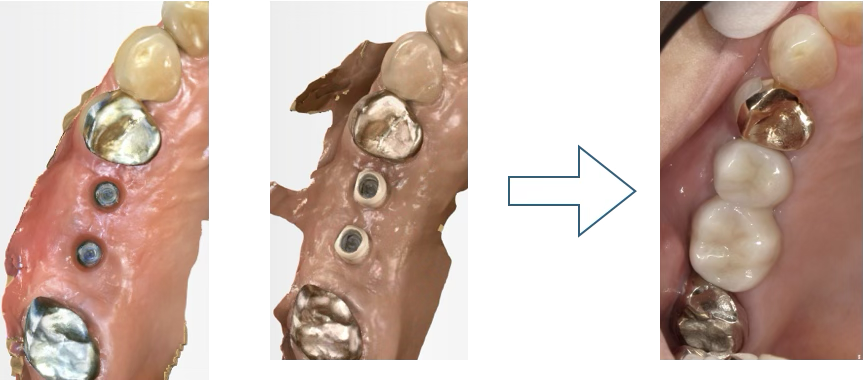 デジタルスキャンを用いたインプラント補綴