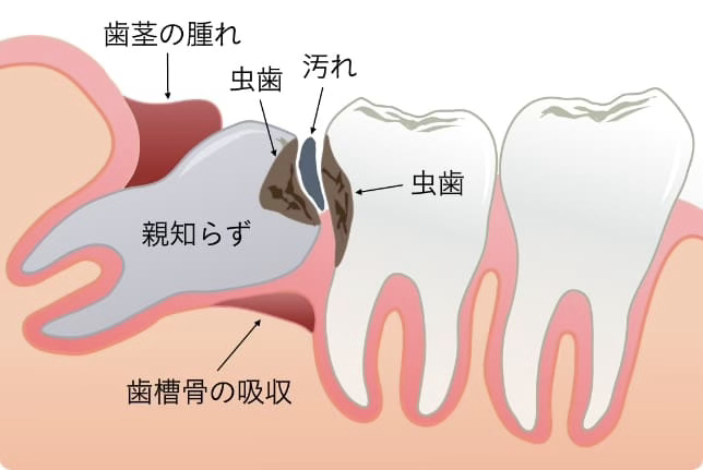 親知らず