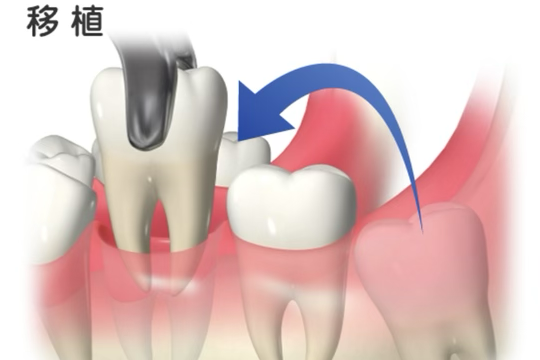 自家歯牙移植