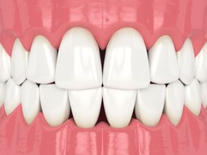 歯の隙間が気になる方へ。主な原因と治療法について