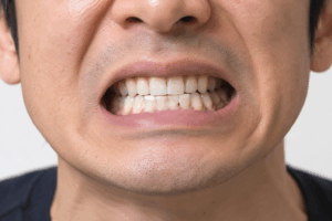 ⻭ぎしり・食いしばりの原因とは?〜マウスピース治療の効果〜